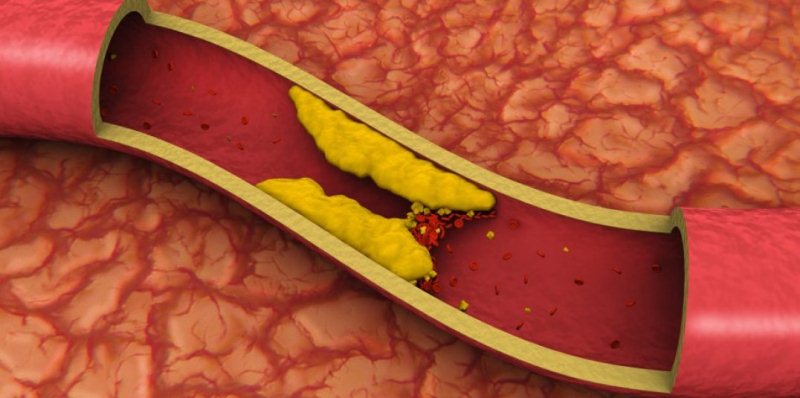 Study shows direct relationship between Alzheimer   s tau protein and Cholesterol