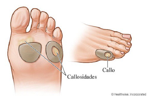 Cómo tratar naturalmente los callos