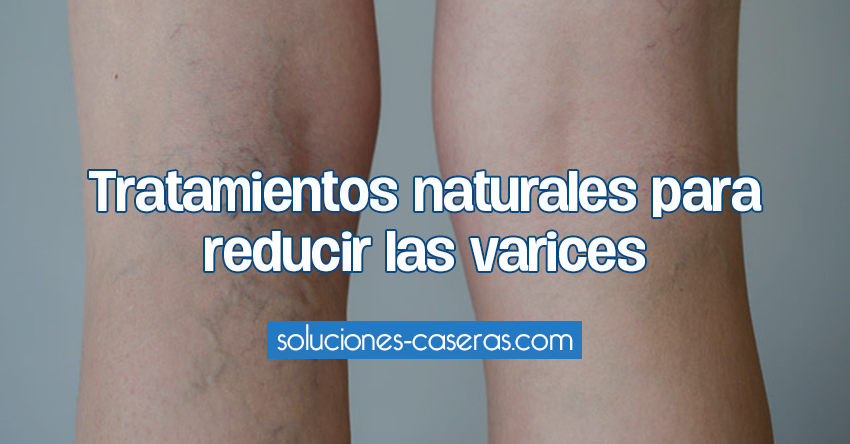 Tratamientos naturales para reducir las varices