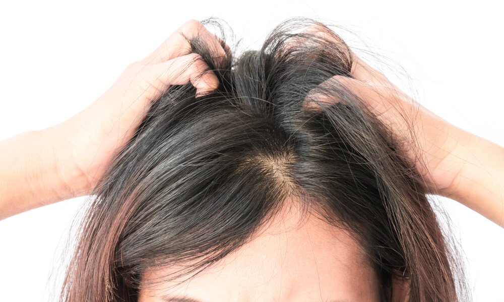 ¿Tienes caspa en tu cabello? Dile adiós con un tratamiento de huevo