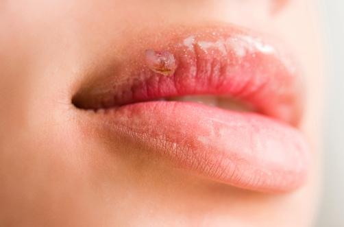 8 remedios caseros y recomendaciones para el herpes simple