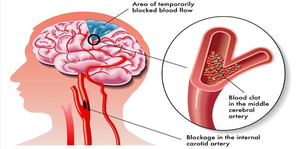 Harvard Study: 7 Ways To Prevent A Stroke Before You   re 40