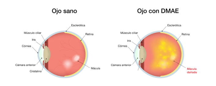 Se descubre la cura para la pérdida de visión por degeneración macular