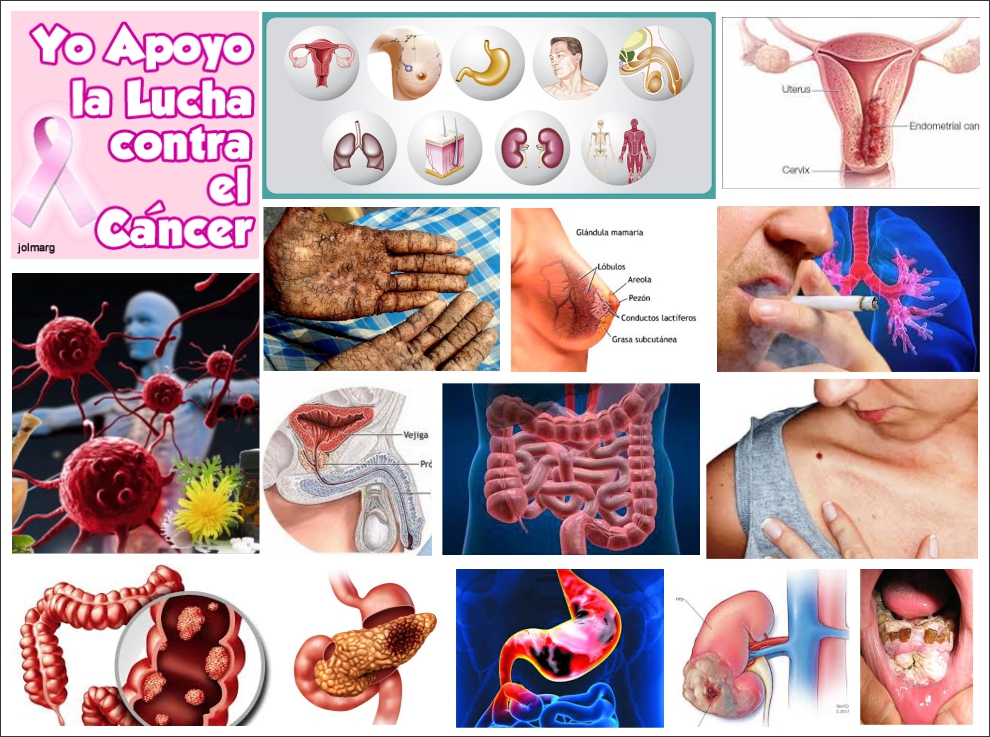  Limitar el consumo de carnes, grasas y alcohol podría reducir el riesgo de cáncer en un 40%