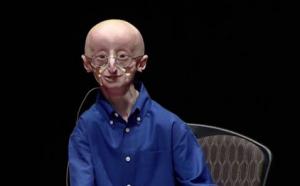 A los 17 años, murió Sam Berns, que sufría la enfermedad de Benjamin Button