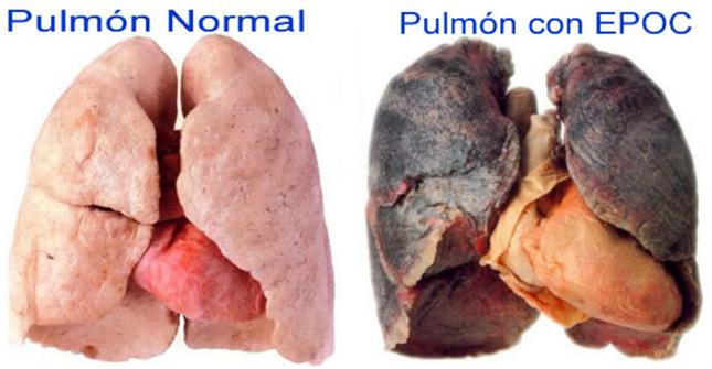 EPOC, el verdugo de los fumadores