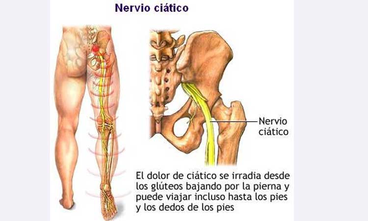 DOLOR  DE CIÁTICA TRATAMIENTO CASERO