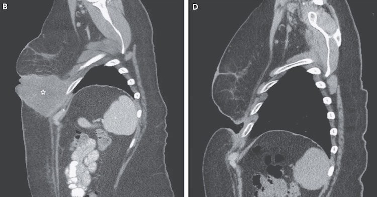 In Successful Cancer Trial, Therapy "Dissolves" Stage IV Tumor in 3 Weeks